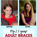 Adult Braces Journey Before and After Pictures