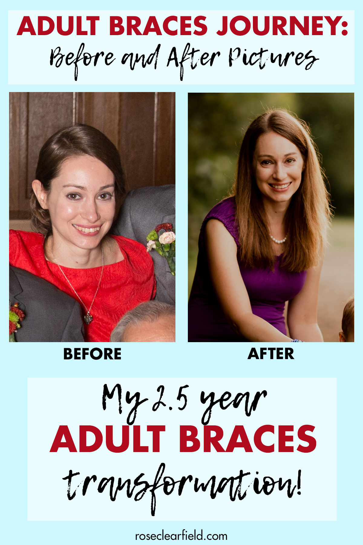 before and after braces adults